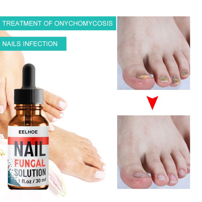 Hand and Foot Onychomycosis Care And Repair Liquid