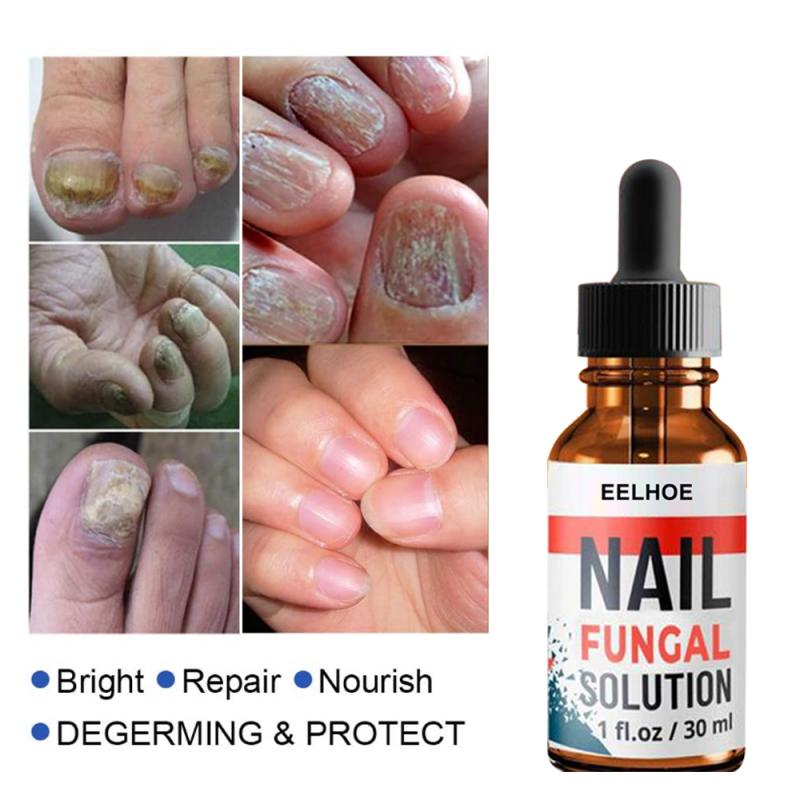 Hand and Foot Onychomycosis Care And Repair Liquid